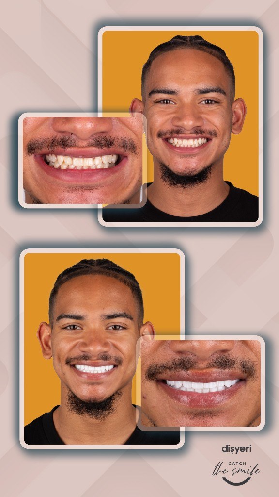 Transformation du sourire avant et après 1