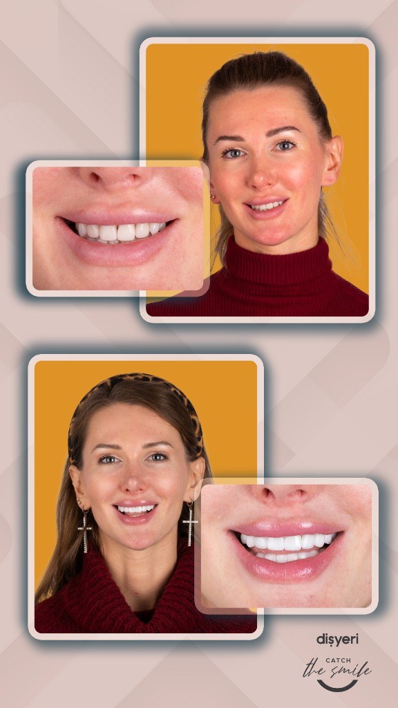 Transformation du sourire avant et après 2