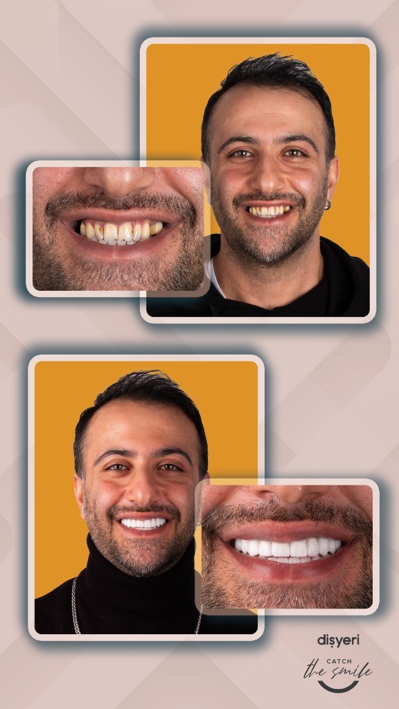 Transformation du sourire avant et après 3