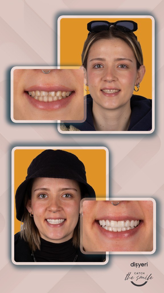 Transformation du sourire avant et après 4 ans