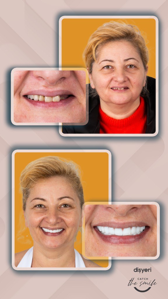 Transformation du sourire avant et après 5 ans