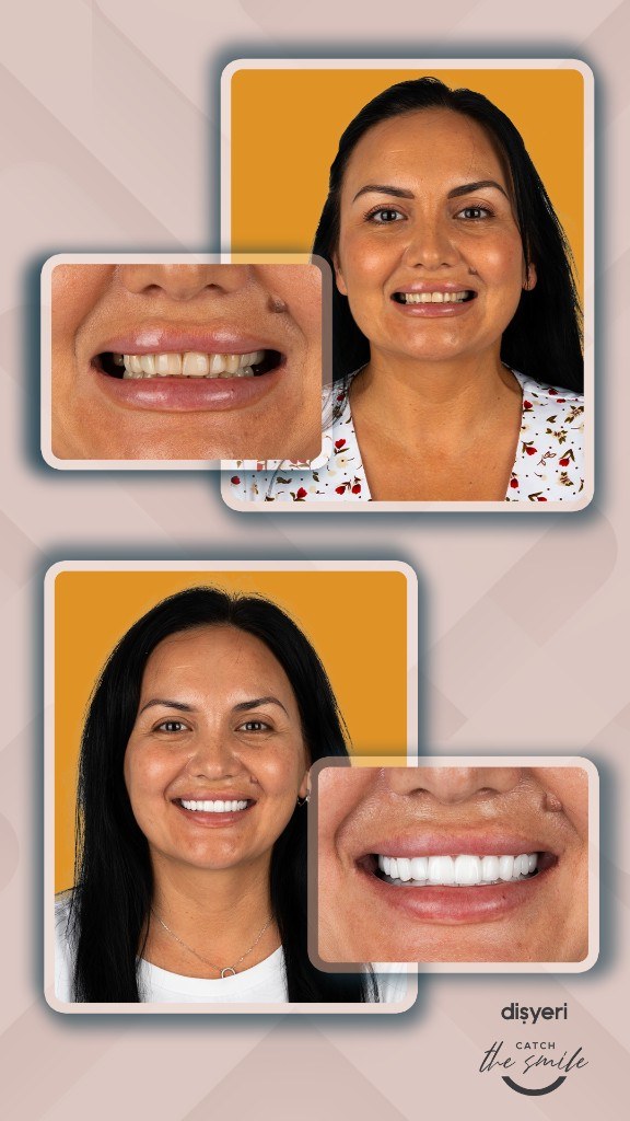 Transformation du sourire avant et après 6 ans