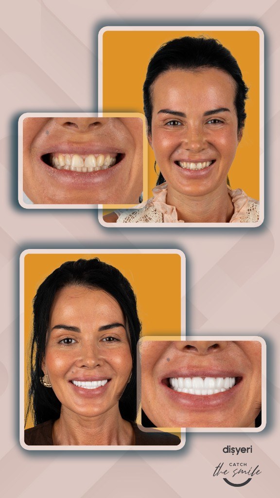 Transformation du sourire avant et après 7 ans