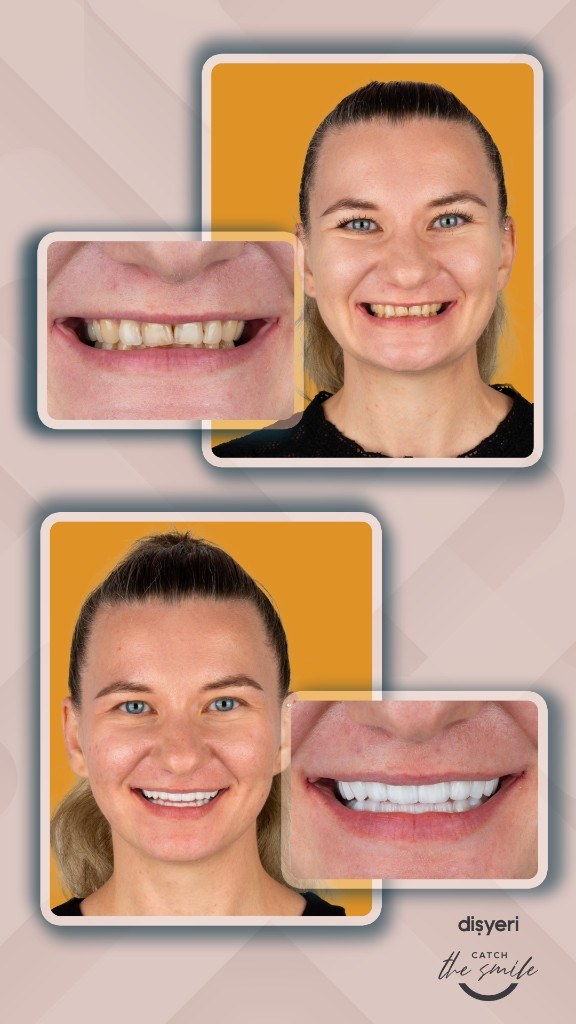 Transformation du sourire avant et après 8 ans