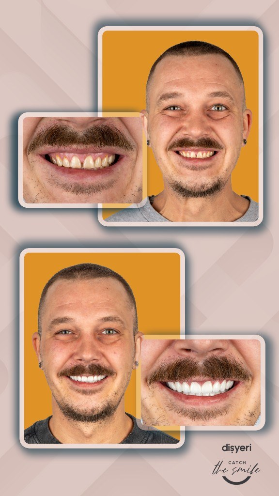 Transformation du sourire avant et après 9 heures