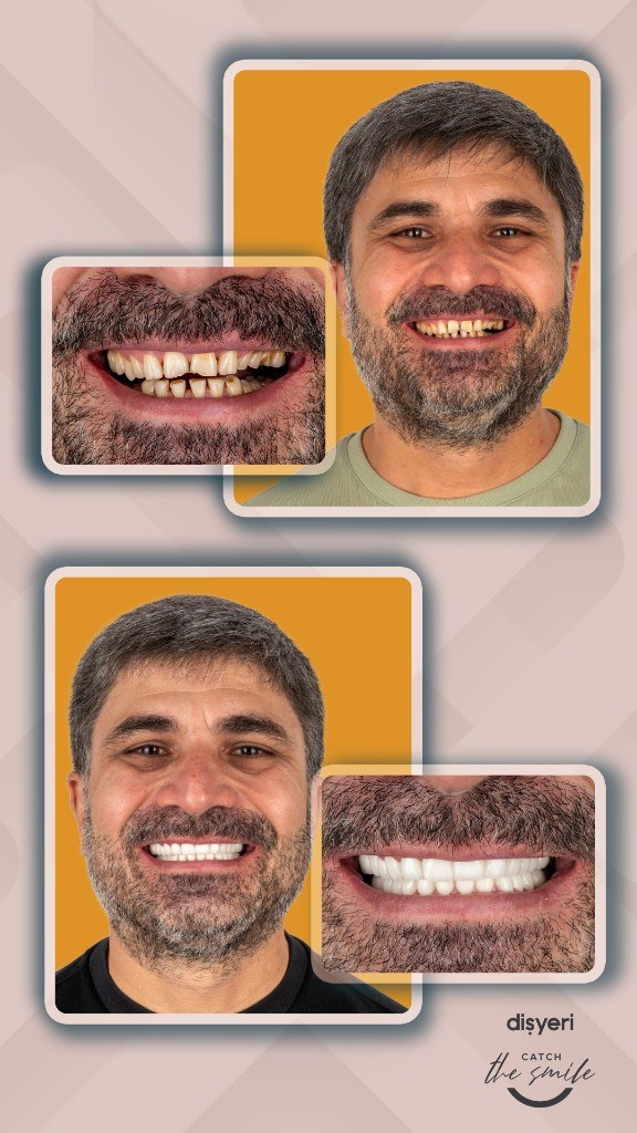 Transformation du sourire avant et après 10 heures
