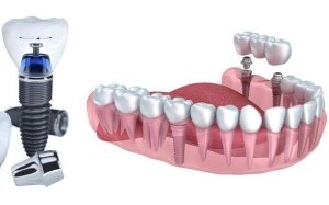 Implant Dentaire